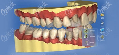 福州贝臣3D手术导板技术