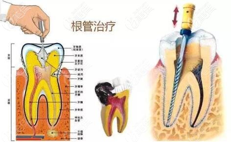 根管治疗 根管治疗