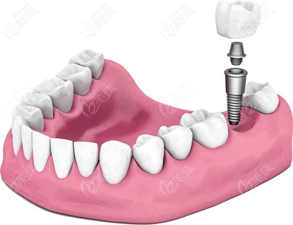 登特斯种植牙的手术原理