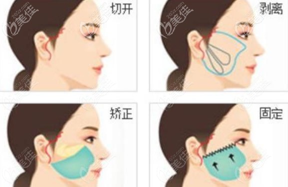面部大拉皮手术操作流程