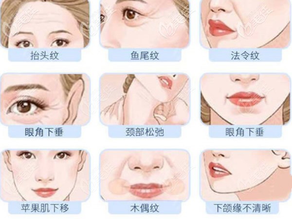 拉皮手术能改善哪些面部问题