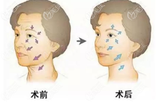 拉皮手术对比照片