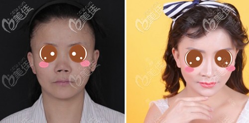 北京刘彦军鼻修复案例