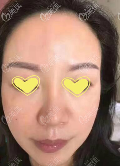 脸下垂用人工韧带提升会伤面部神经吗?过来人说说自己的亲身经历