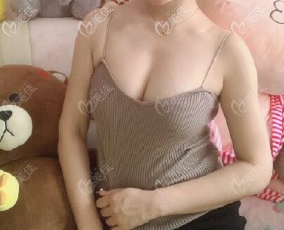 人工韧带乳房上提术后三个月效果