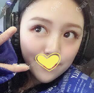 打伊婉玻尿酸丰下巴术后一个月效果图 打伊婉玻尿酸丰下巴术后一个月效果图