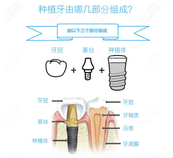 种植牙内部机构图包括牙冠基台种植体