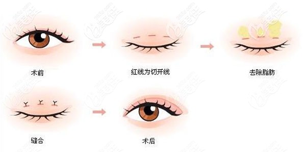 江腾医生做切开双眼皮的技术优势