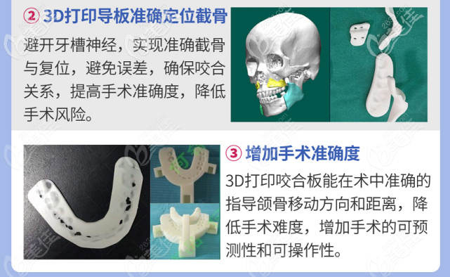 广州广大3d打印导板正颌手术优势