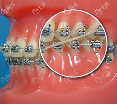 正畸橡皮筋的作用