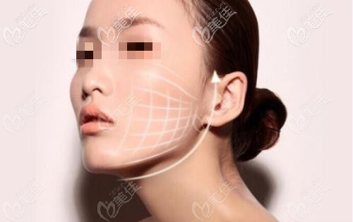 单线的进针方向