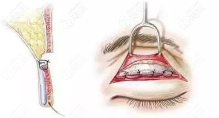 切开双眼皮形态 切开双眼皮形态