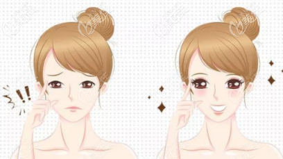 双眼皮动画图示 双眼皮动画图示