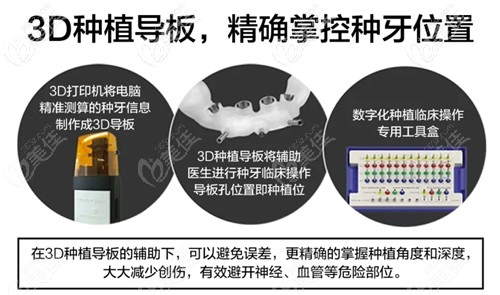 长春超龙牙3D种植牙导板