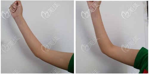 手臂吸脂术后3个月效果 手臂吸脂术后3个月效果