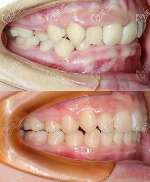 矫正的前后对比