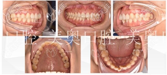 术前牙齿拥挤参差不齐 术前牙齿拥挤参差不齐
