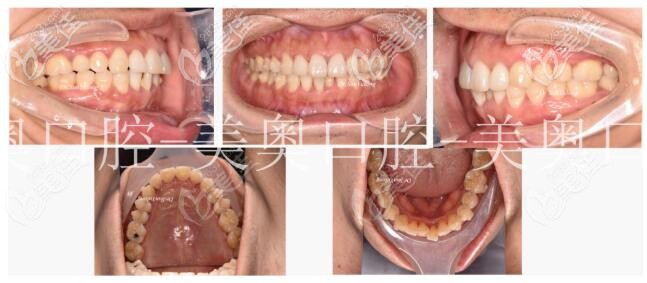 拥挤的牙齿不用拔牙，常州美奥医生只是用无托槽隐形矫治器就正畸成功了呢