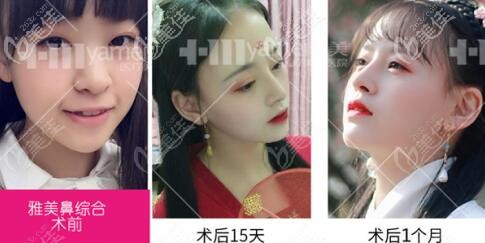 长沙雅美鼻综合真人前后对比案例照 长沙雅美鼻综合真人前后对比案例照