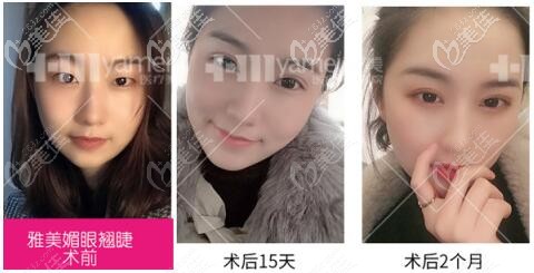 长沙雅美双眼皮整形真人前后对比案例照 长沙雅美双眼皮整形真人前后对比案例照