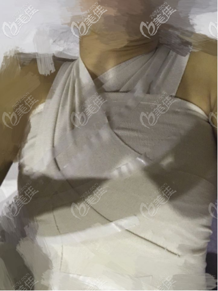 第二次脂肪隆胸后即刻的照片