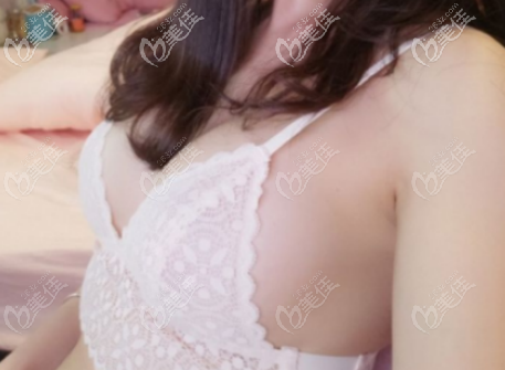 这是第二次脂肪隆胸后的胸部