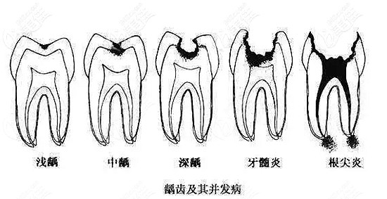 浅龋,中龋补牙即可当蛀牙的病变只是到达牙釉质层或牙本质层时,叫龋