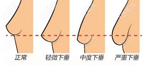 胸下垂的程度决定了手术方法 胸下垂的程度决定了手术方法