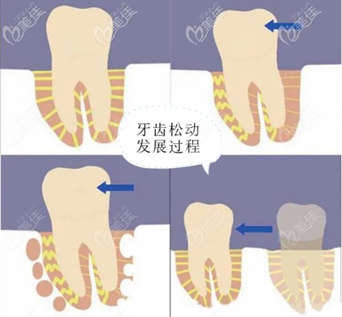 牙周炎导致的牙齿松动发展过程图