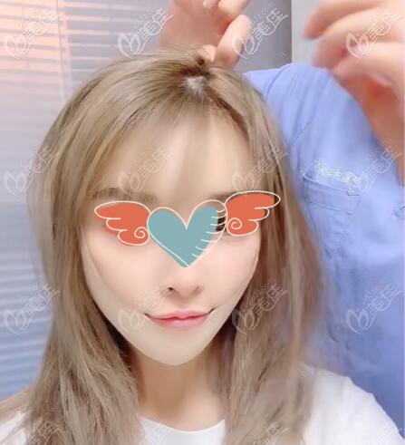 水剥离拉皮除皱真实案例效果 水剥离拉皮除皱真实案例效果