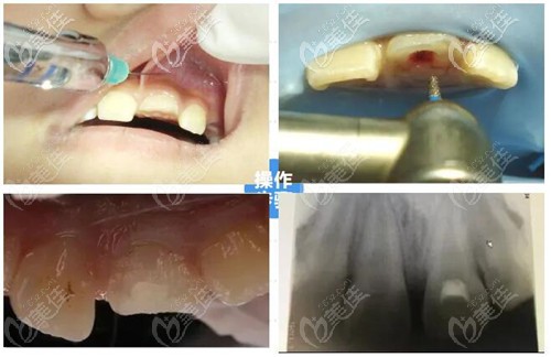 活髓切断术治疗过程