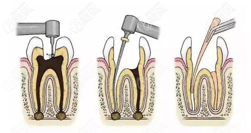 根管治疗步骤过程