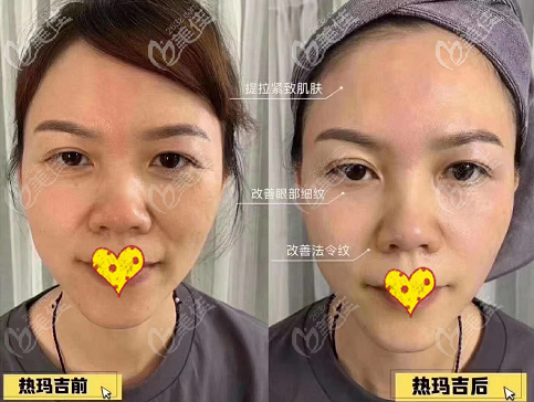 第四代热玛吉全面部1200发效果图 第四代热玛吉全面部1200发效果图