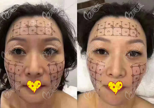 热玛吉面部900发改善法令纹效果图 热玛吉面部900发改善法令纹效果图