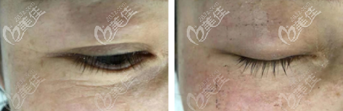 热玛吉4代眼周450发效果图 热玛吉4代眼周450发效果图