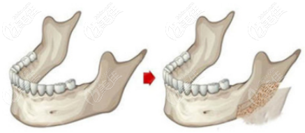 外板劈除手术部位