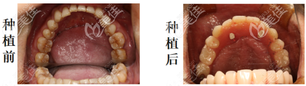 种植前后对比照片 种植前后对比照片