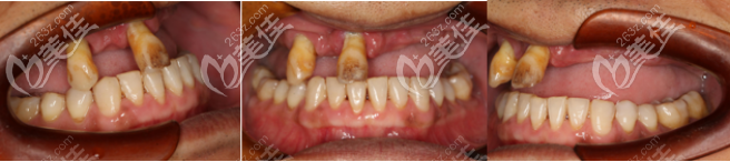 术前牙齿状况 术前牙齿状况