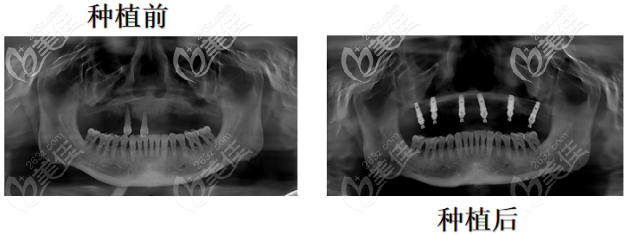 Ct片下的牙部形态 Ct片下的牙部形态