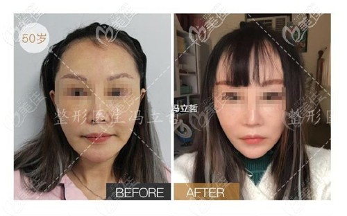 冯立哲面部除皱手术实例图 冯立哲面部除皱手术实例图