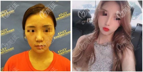 付俊俐医生肋骨鼻综合案例