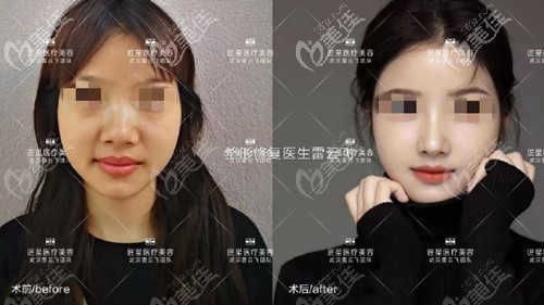 武汉匠星雷云飞鼻综合案例