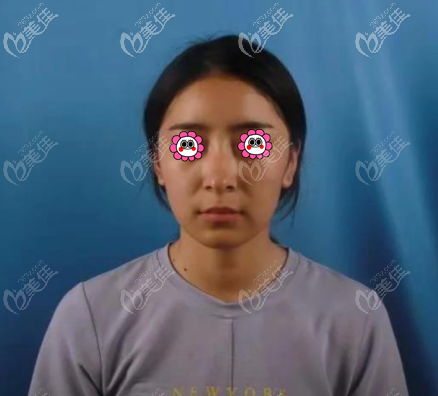 我做国产康宁硅胶假体隆鼻前 我做国产康宁硅胶假体隆鼻前