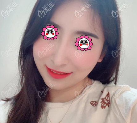 在北京童仁做国产康宁硅胶假体隆鼻2个多月 在北京童仁做国产康宁硅胶假体隆鼻2个多月