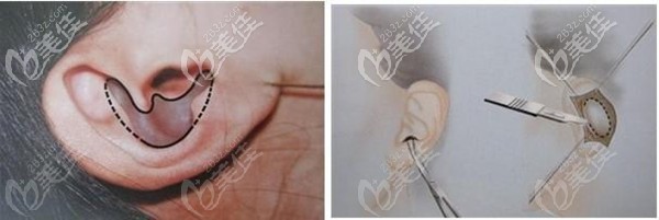 裴彦鹏医生做耳软骨鼻综合手术