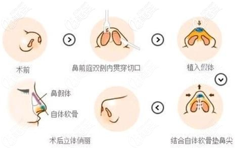 周杰医生做耳软骨鼻综合手术过程