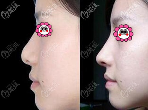 美国旭尔挺隆鼻案例