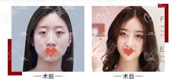 南京华韩奇致肋骨隆鼻案例