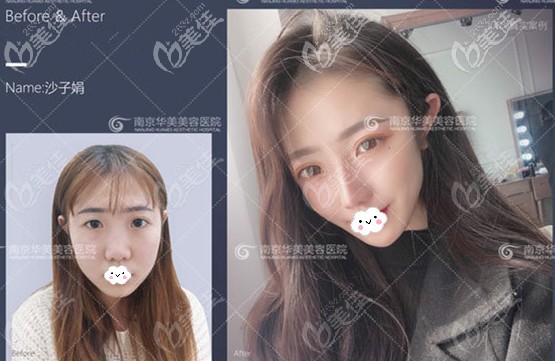 南京华美隆鼻案例