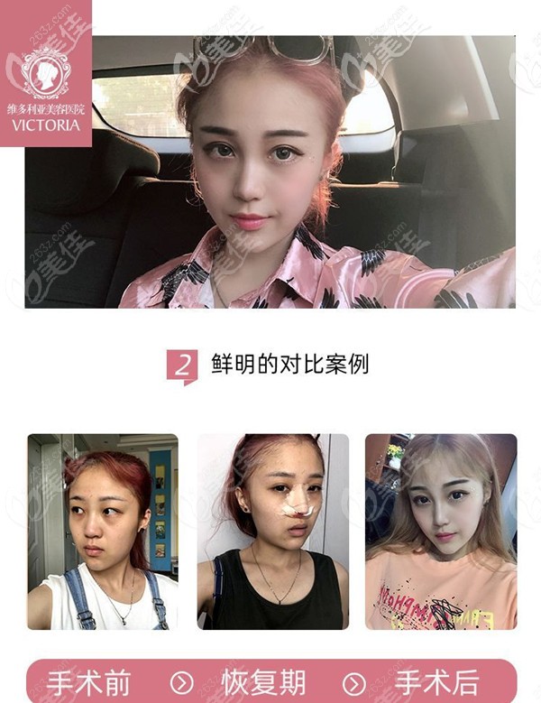 南京维多利亚膨体+肋软骨案例